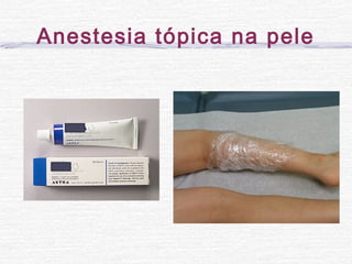 Anestesia tópica na pele
 