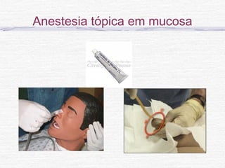 Anestesia tópica em mucosa
 