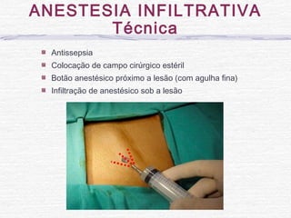 Antissepsia
Colocação de campo cirúrgico estéril
Botão anestésico próximo a lesão (com agulha fina)
Infiltração de anestésico sob a lesão
ANESTESIA INFILTRATIVA
Técnica
 