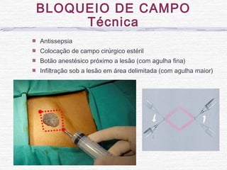 Antissepsia
Colocação de campo cirúrgico estéril
Botão anestésico próximo a lesão (com agulha fina)
Infiltração sob a lesão em área delimitada (com agulha maior)
BLOQUEIO DE CAMPO
Técnica
 