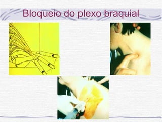 Bloqueio do plexo braquial
 