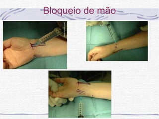 Bloqueio de mão
 