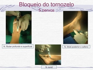 Bloqueio do tornozelo
5 nervos
N. fibular profundo e superficial N. tibial posterior e safeno
N. sural
 