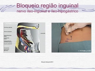 Bloqueio região inguinal
nervo íleo-inguinal e íleo-hipogástrico
Bloqueio ilioinguinal.MOV
 