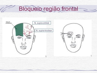 Bloqueio região frontal
N. supra-orbital
N. supra-troclear
 