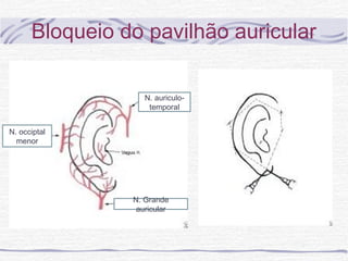Bloqueio do pavilhão auricular
N. Grande
auricular
N. auriculo-
temporal
N. occiptal
menor
 