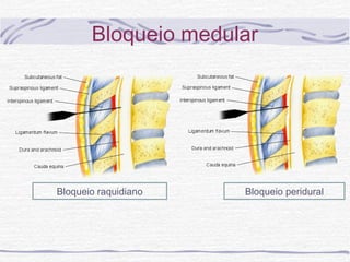 Bloqueio medular
Bloqueio raquidiano Bloqueio peridural
 