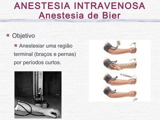 Objetivo
Anestesiar uma região
terminal (braços e pernas)
por períodos curtos.
ANESTESIA INTRAVENOSA
Anestesia de Bier
 
