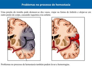Problemas no processo de hemostasia
Uma porção do trombo pode destacar-se dos vasos, viajar na forma de êmbolo e alojar-se em
outro ponto do corpo, causando isquemia e/ou enfarte.
Problemas no processo de hemostasia também podem levar a hemorragias.
 