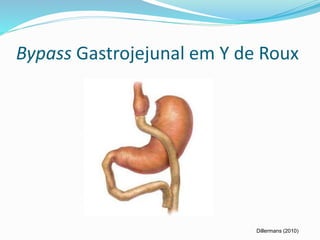 Bypass Gastrojejunal em Y de Roux 
Dillermans (2010) 
 