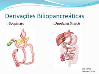 Derivações Biliopancreáticas 
Scopinaro Duodenal Switch 
Garg (2010) 
Dillermans (2010) 
 