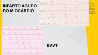 INFARTO AGUDO
DO MIOCÁRDIO
BAVT
 
