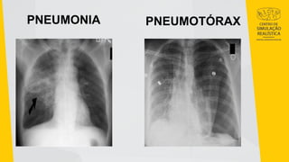 PNEUMONIA PNEUMOTÓRAX
 