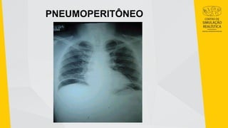 PNEUMOPERITÔNEO
 