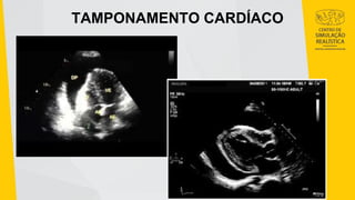TAMPONAMENTO CARDÍACO
 