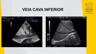 VEIA CAVA INFERIOR
 