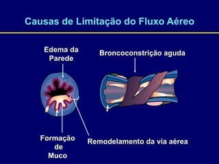 Causas de Limitação do Fluxo Aéreo
Broncoconstrição aguda
Edema da
Parede
Formação
de
Muco
Remodelamento da via aérea
 