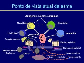 Ponto de vista atual da asma
Tampão mucoso
Extravasamento
de plasma
Antígenos e outros estímulos
Mastócito
Macrófago
Linfócito-T Neutrófilo
Eosinófilo
Nervo sensitivo
Nervo eferente
Broncoconstrição
Edema
Ruptura epitelial
Fibrose subepitelial
 