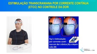 ESTIMULAÇÃO TRANSCRANIANA POR CORRENTE CONTÍNUA
(ETCC) NO CONTROLE DA DOR
 