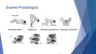 Exame Proctológico
34
1)Decúbito lateral 2)abaixado 3)Posição genupeitoral 4)posição de litotomia
 