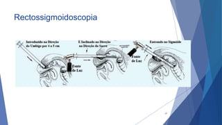 Rectossigmoidoscopia
37
 