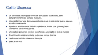 Colite Ulcerosa
 Os processos patológicos envolvem a mucosa e submucosa, sem
comprometimento da camada muscular.
 Inflamação interrupta da mucosa colónica desde o recto distal que se estende
ao cólon ascendente
 Aparência macroscópica: mucosa hiperémica, friável, com granulações e
úlceras nos casos mais graves
 Ulcerações: pequenas erosões superficiais à ulceração de toda a mucosa
 Envolvimento rectal (proctite) é o sine qua non da doença
 Lesão característica: abcessos da cripta
 pANCA em 86%
43
 