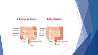  Doença de Crohn Colite Ulcerosa
49
 