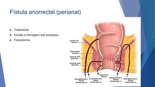 Fístula anorrectal (perianal)
 Tratamento
 Incisão e drenagem sob anestesia
 Fistulotomia
57
 