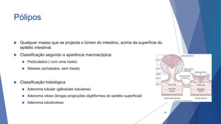 Pólipos
 Qualquer massa que se projecta o lúmen do intestino, acima da superfície do
epitélio intestinal.
 Classificação segundo a aparência macroscópica:
 Pediculados ( com uma haste)
 Sésseis (achatados, sem haste)
 Classificação histológica
 Adenoma tubular (glândulas tubulares)
 Adenoma viloso (longas projecções digitiformes do epitélio superficial)
 Adenoma tubuloviloso
59
 