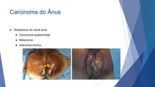 Carcinoma do Ânus
 Neoplasias do canal anal:
 Carcinoma epidermóide
 Melanoma
 Adenocarcinoma
71
 