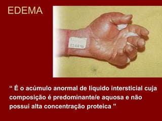 EDEMA
“ É o acúmulo anormal de líquido intersticial cuja
composição é predominante/e aquosa e não
possui alta concentração proteica ”
 