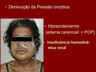 • Diminuição da Pressão oncótica
• Hipoproteinemia
(edema carencial: > POP)
• Insuficiência hemodinâ-
mica renal
 