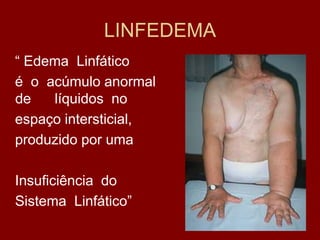 LINFEDEMA
“ Edema Linfático
é o acúmulo anormal
de líquidos no
espaço intersticial,
produzido por uma
Insuficiência do
Sistema Linfático”
 