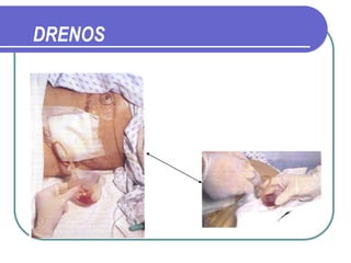DRENOS
 