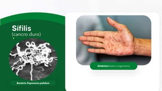 (cancro duro)
Bactéria Treponema palidum
Sistêmica (todo o organismo)
 