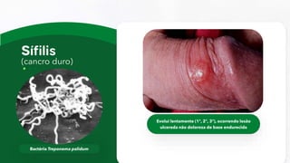 (cancro duro)
Bactéria Treponema palidum
Evolui lentamente (1ª, 2ª, 3ª), ocorrendo lesão
ulcerada não dolorosa de base endurecida
 