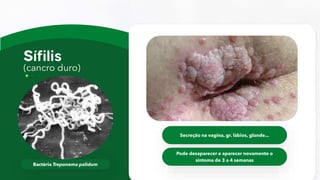 (cancro duro)
Bactéria Treponema palidum
Secreção na vagina, gr. lábios, glande...
Pode desaparecer e aparecer novamente o
sintoma de 3 a 4 semanas
 