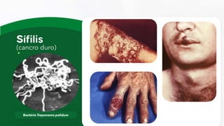 (cancro duro)
Bactéria Treponema palidum
 