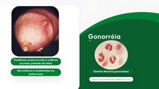 Bactéria Neisseria gonorroheae
Purulência, coceira na uretra e ardência
ao urinar, podendo dar febre
Nas mulheres é assintomática em
muitos casos
Possui uma proteína de resistência à urina
 