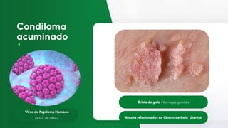 Virus do Papiloma Humano
(Vírus de DNA)
Crista de galo - Verrugas genitais
Alguns relacionados ao Câncer de Colo Uterino
 