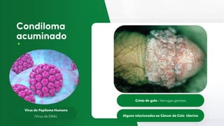 Virus do Papiloma Humano
(Vírus de DNA)
Crista de galo - Verrugas genitais
Alguns relacionados ao Câncer de Colo Uterino
 