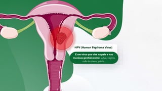 HPV (Human Papiloma Virus)
É um vírus que vive na pele e nas
mucosas genitais como: vulva, vagina,
colo do útero, pênis...
 