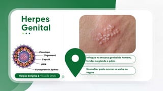 Herpes Simples 2 (Vírus de DNA)
Infecção na mucosa genital do homem,
feridas na glande e pênis
Na mulher pode ocorrer na vulva ou
vagina
 