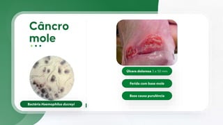 Bactéria Haemophilus ducreyi
Úlcera dolorosa 3 a 50 mm
Ferida com base mole
Base causa purulência
 