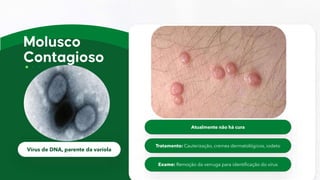 Vírus de DNA, parente da varíola
Atualmente não há cura
Tratamento: Cauterização, cremes dermatológicos, iodeto
Exame: Remoção da verruga para identificação do vírus
 