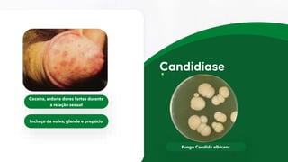 Fungo Candida albicans
Coceira, ardor e dores fortes durante
a relação sexual
Inchaço da vulva, glande e prepúcio
 