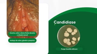 Fungo Candida albicans
Coceira, ardor e dores fortes durante
a relação sexual
Inchaço da vulva, glande e prepúcio
 