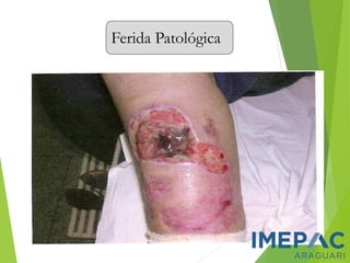 Ferida Patológica
 