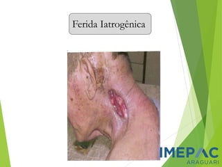 Ferida Iatrogênica
 