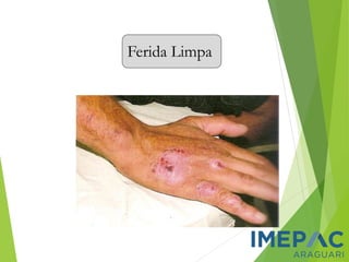 Ferida Limpa
 